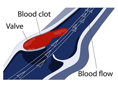 Deep Vein Thrombosis