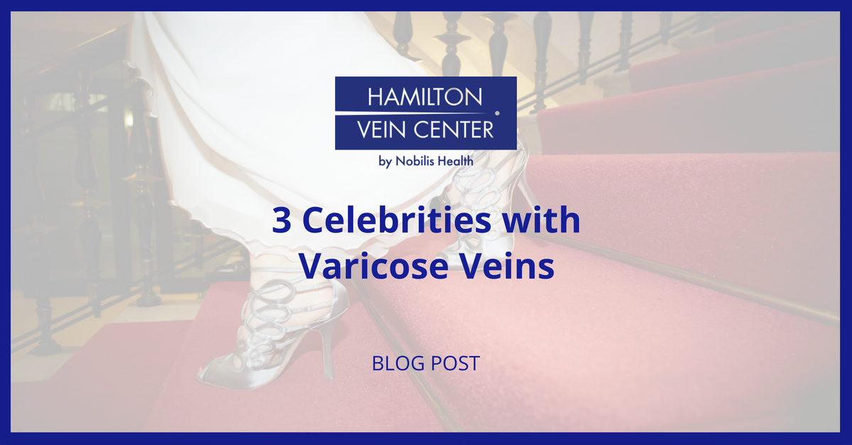 varicose veins