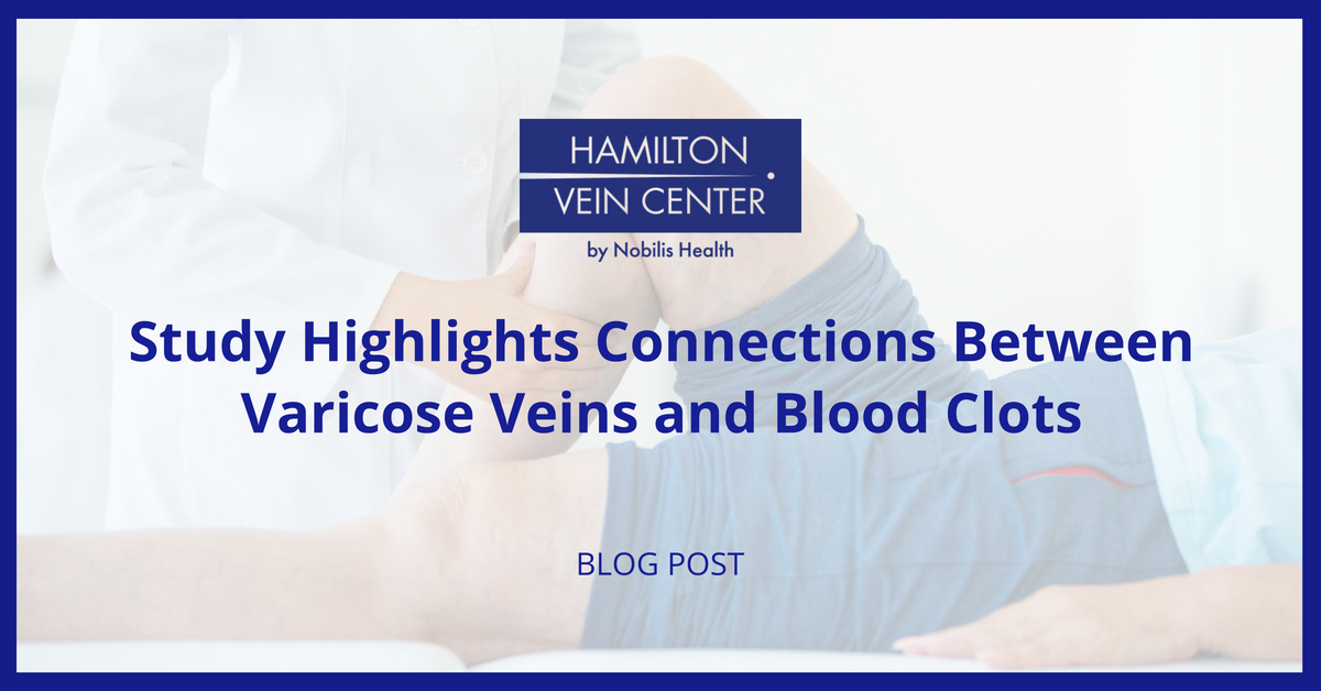 varicose veins